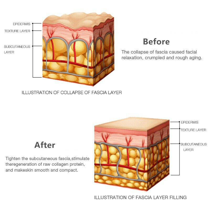 Mini Hifu Ultrasound Machine Face Lifting Skin Tighten Wrinkle Reduction Facial DIAGNOSTIC ULTRASOUND MACHINES FOR SALE