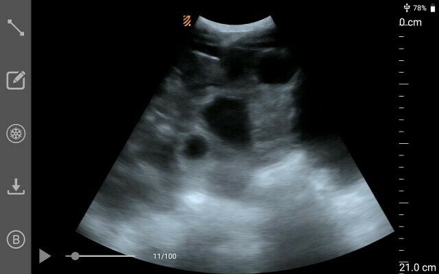 MX5 Go Portable Ultrasound The World’S First App-Based Swine Ultrasound DIAGNOSTIC ULTRASOUND MACHINES FOR SALE