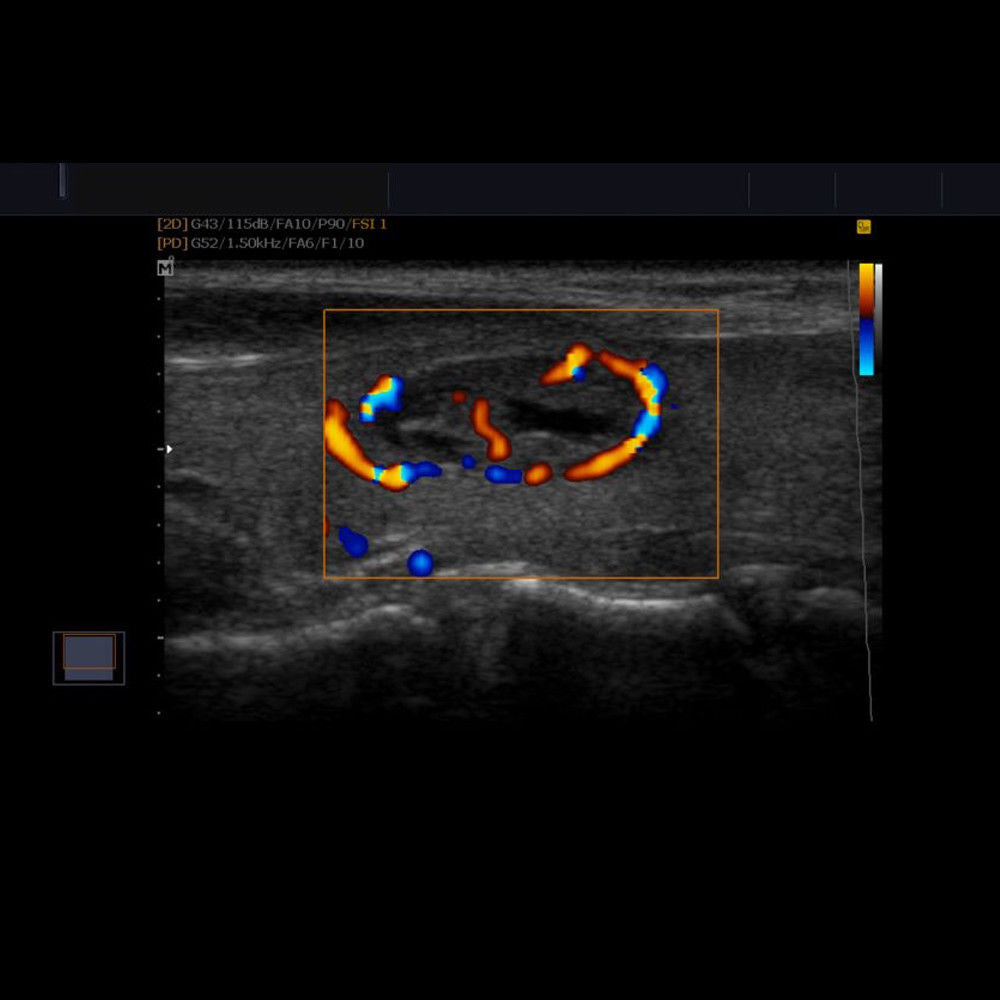 Samsung Ultrasound System - Medison SonoAce R7 Machine (+) HL5-12EDN (LINEAR) DIAGNOSTIC ULTRASOUND MACHINES FOR SALE