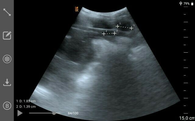 MX5 Go Portable Ultrasound The World’S First App-Based Swine Ultrasound DIAGNOSTIC ULTRASOUND MACHINES FOR SALE