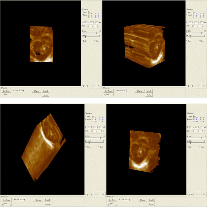 Full Digital Laptop 3D Ultrasound Scanner 6.5 MHZ transvaginal Probe Pregnancy DIAGNOSTIC ULTRASOUND MACHINES FOR SALE