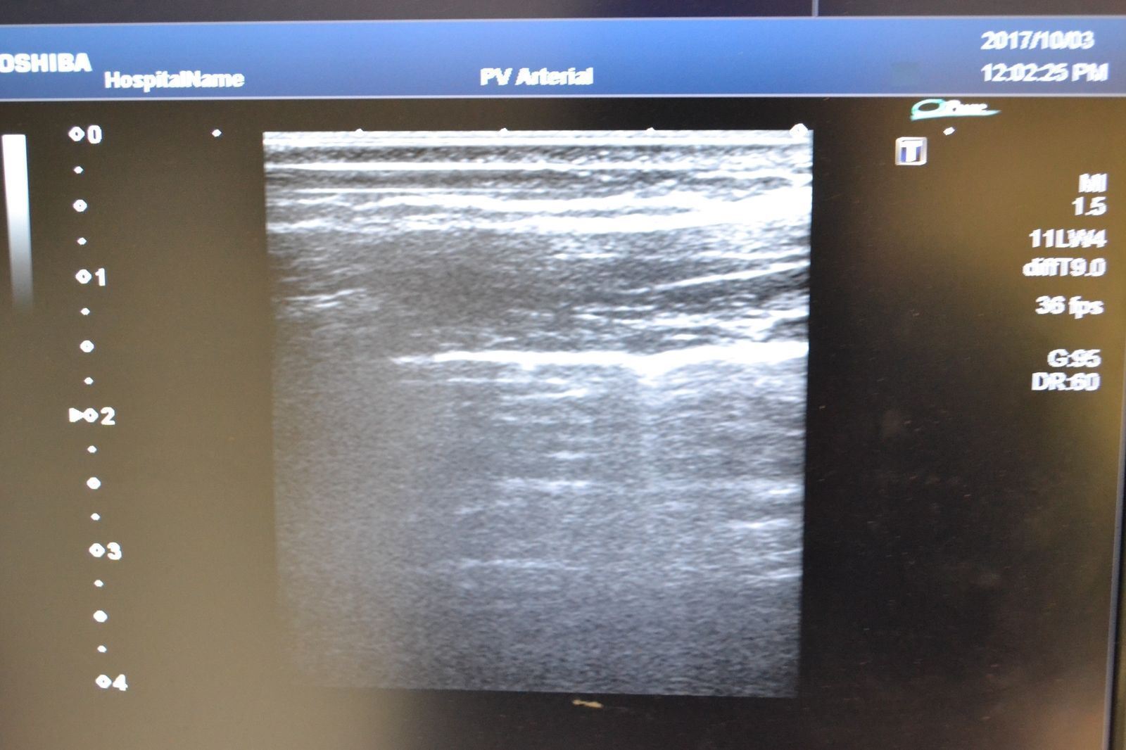 Toshiba Artida PLT-704SBT 11-4.8MHz Linear Ultrasound Transducer Probe J1629 DIAGNOSTIC ULTRASOUND MACHINES FOR SALE