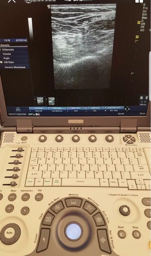 GE Logiq E 2007 Portable Ultrasound With 1 Probe. DIAGNOSTIC ULTRASOUND MACHINES FOR SALE