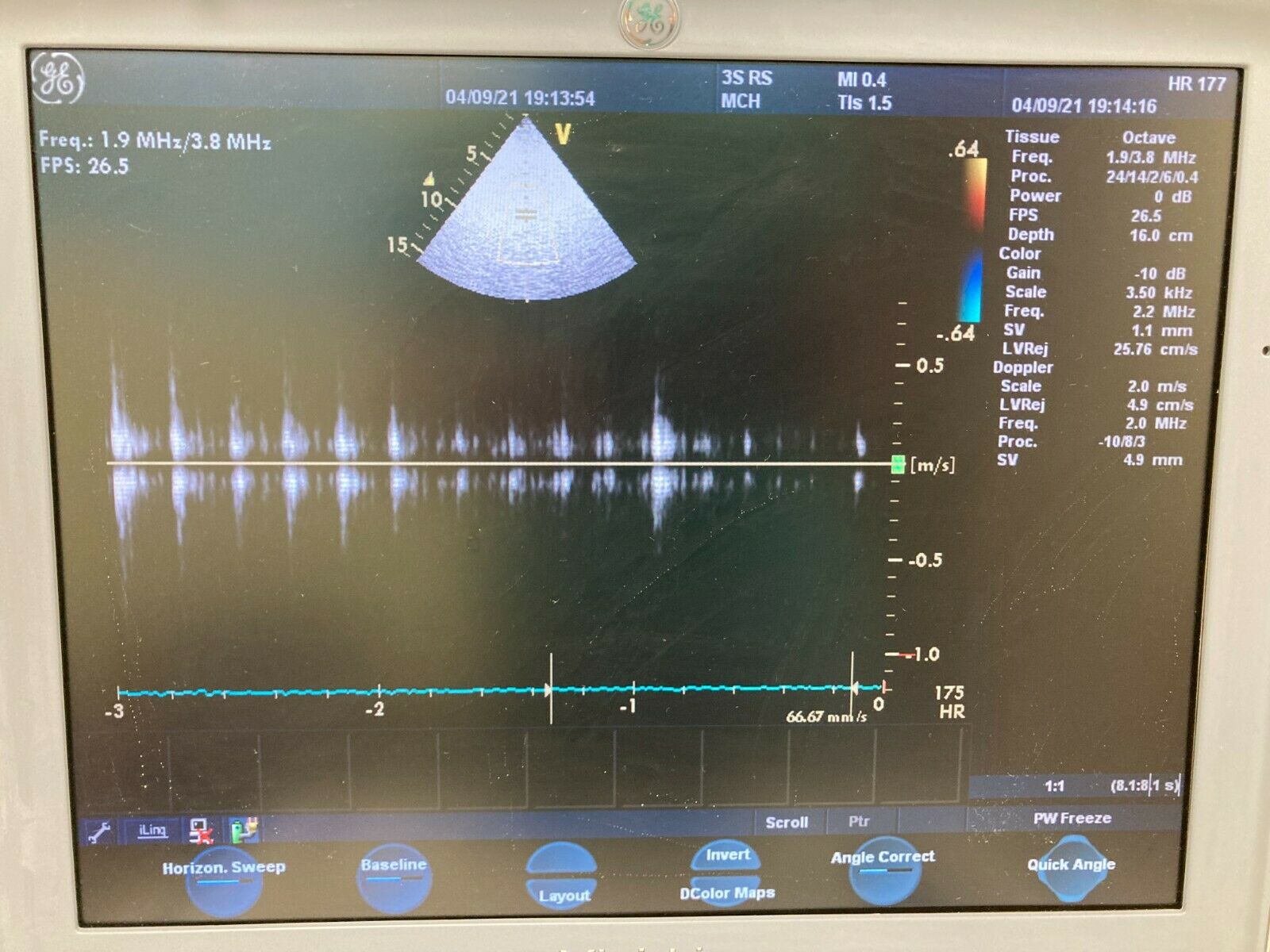 GE VIVID I BTO6 PORTABLE ULTRASOUND MACHINE WITH 3 PROBES and Cart. DIAGNOSTIC ULTRASOUND MACHINES FOR SALE