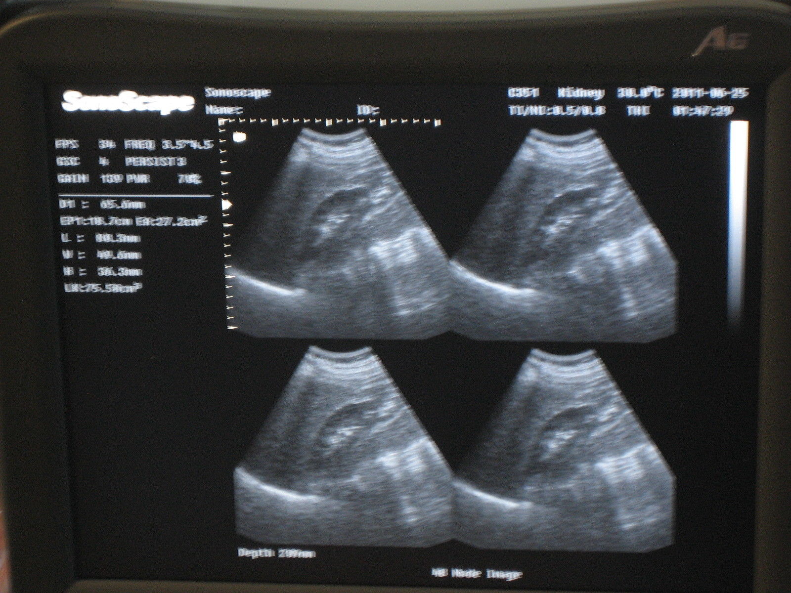 Ultrasound SonoScape A6 B/W with one transducer DIAGNOSTIC ULTRASOUND MACHINES FOR SALE