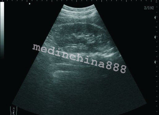 Digital LCD Ultrasound Scanner Machine+Convex + Linear Probe+Sony Printer 190891246417 DIAGNOSTIC ULTRASOUND MACHINES FOR SALE