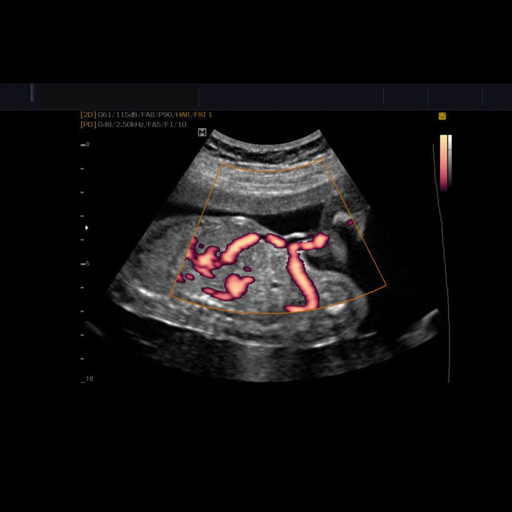 Samsung Ultrasound System - Medison SonoAce R7 Machine (+) HL5-12EDN (LINEAR) DIAGNOSTIC ULTRASOUND MACHINES FOR SALE