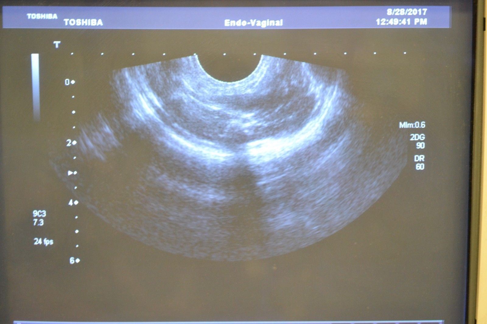 Toshiba Aplio 300 PVT-661VT 8.8-3.6 MHz Endorectal Ultrasound Transducer Probe DIAGNOSTIC ULTRASOUND MACHINES FOR SALE