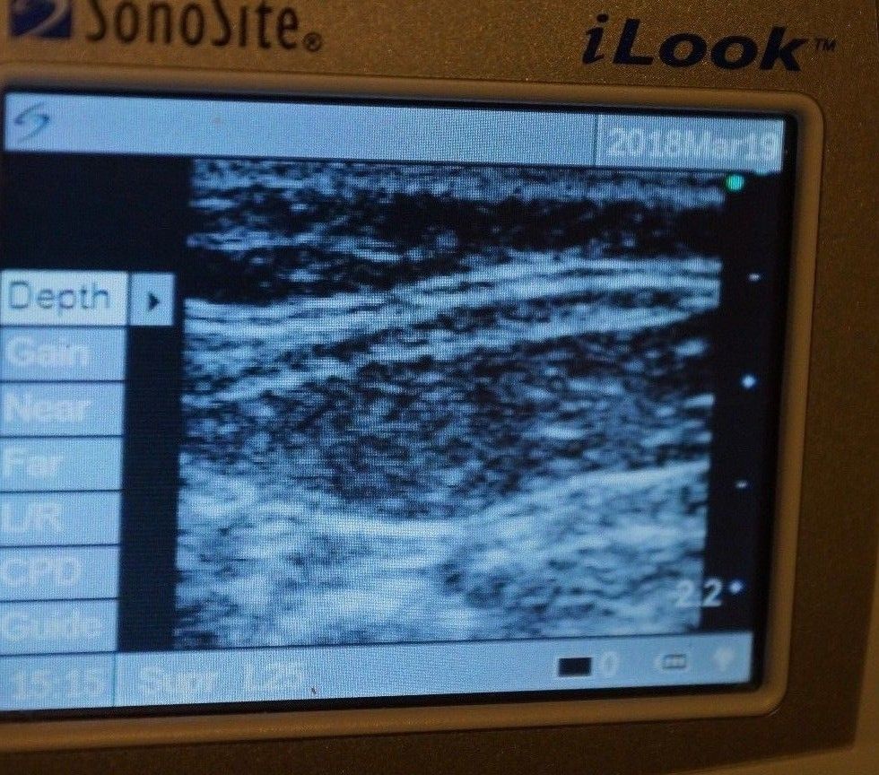 Ultrasound Sonosite iLook 25 with Linear Probe Power adapter and Battery DIAGNOSTIC ULTRASOUND MACHINES FOR SALE