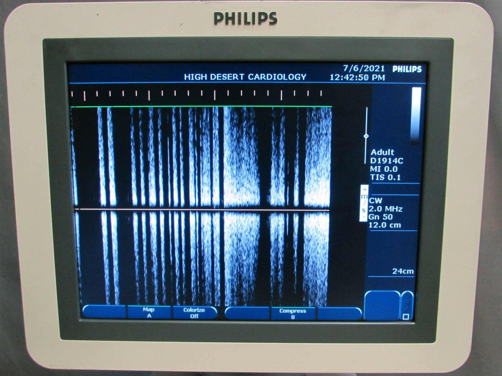 Philips HD7XE Diagnostic Ultrasound System with 2 Transducers & Doppler Probe DIAGNOSTIC ULTRASOUND MACHINES FOR SALE