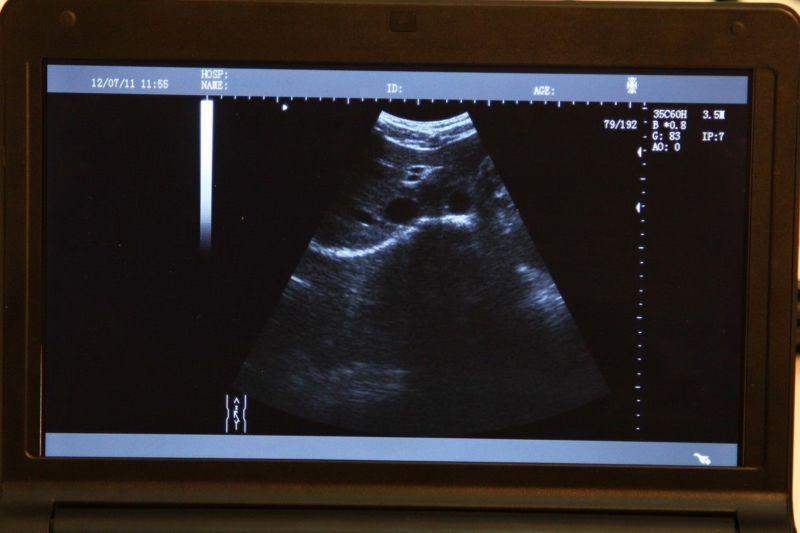 Fast Notebook Laptop Ultrasound Scanner Machine 6.5 MHZ Transvaginal Probe + 3D DIAGNOSTIC ULTRASOUND MACHINES FOR SALE