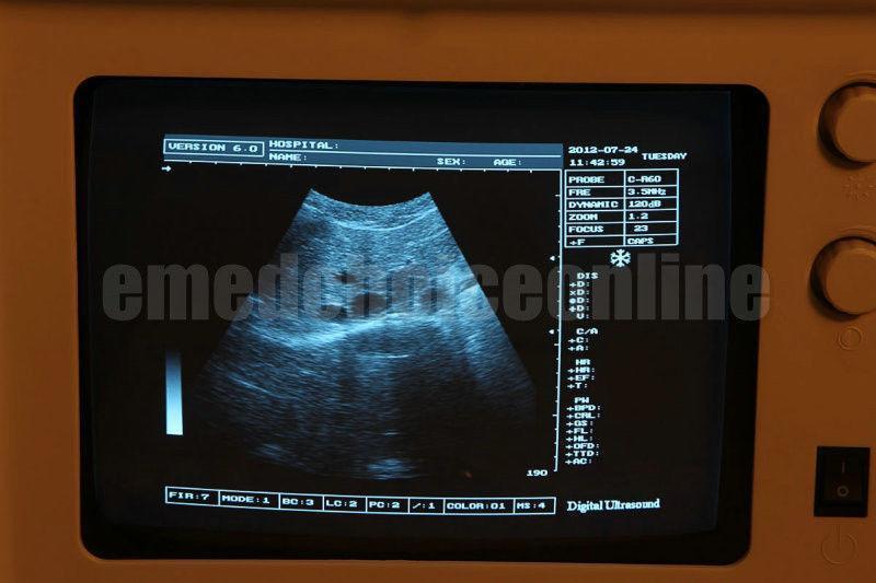 Full Digital Portable Ultrasound Scanner Machine + Linear Probe + 3D Software CE DIAGNOSTIC ULTRASOUND MACHINES FOR SALE