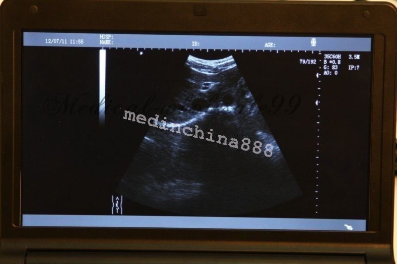 Laptop Ultrasound Scanner +Convex+Linear+Transvaginal 3 Probes Free Aluminum Box DIAGNOSTIC ULTRASOUND MACHINES FOR SALE