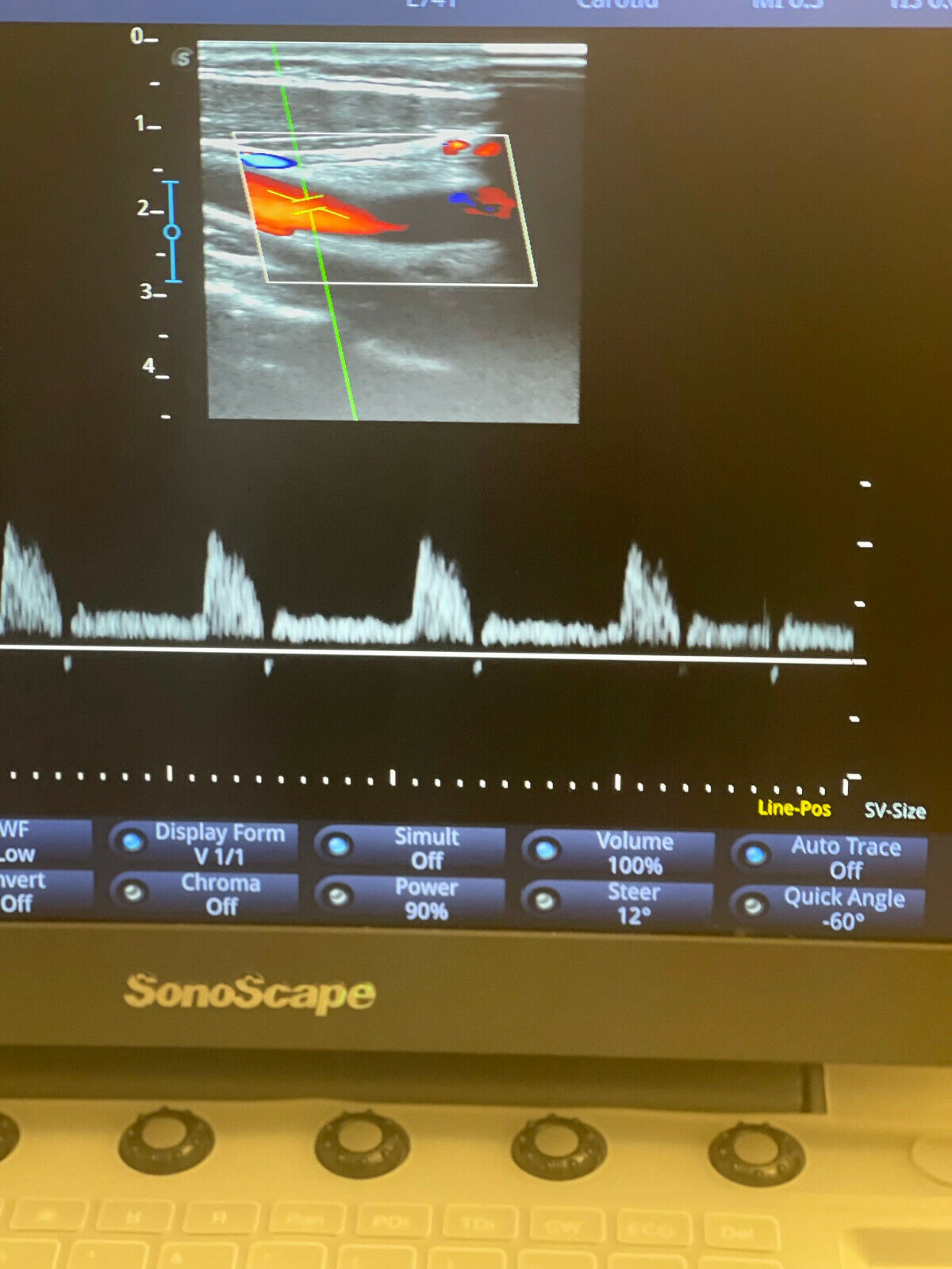 Sonoscape EXP Ultrasound Used, in Excellent condition, only used for 6 Months DIAGNOSTIC ULTRASOUND MACHINES FOR SALE